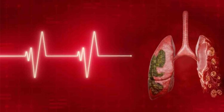 الٹرا پروسیسڈ خوراک اور پھیپھڑوں کے کینسر کے بڑھتے خطرے پر تحقیق اورپھیپھڑوں کے کینسر کا خطرہ