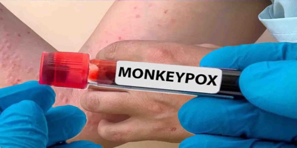 اسلام آباد میں خلیجی ملک سے آنے والے شہری میں منکی پاکس کیس کی تصدیق