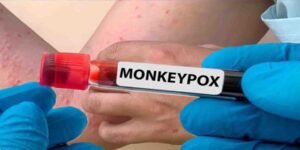 اسلام آباد میں خلیجی ملک سے آنے والے شہری میں منکی پاکس کیس کی تصدیق