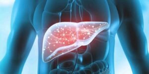 جگر پر چربی