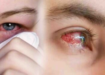 آشوب چشم کی وبا