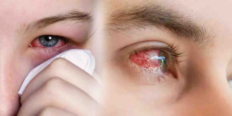 آشوب چشم کی وبا