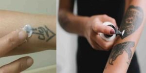 جلد سے ٹیٹو مٹانے والی کریم ایک محفوظ اور مؤثر ایجاد