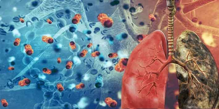 پھیپھڑوں کے کینسر کی وجہ بتانے والی نئی طبی تحقیق