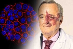 لبلبے کے کینسر کا علاج