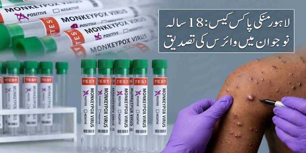 لاہور منکی پاکس کیس