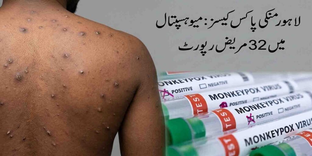 لاہور منکی پاکس کیسز