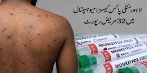 لاہور منکی پاکس کیسز: میو ہسپتال میں 32 مریض رپورٹ