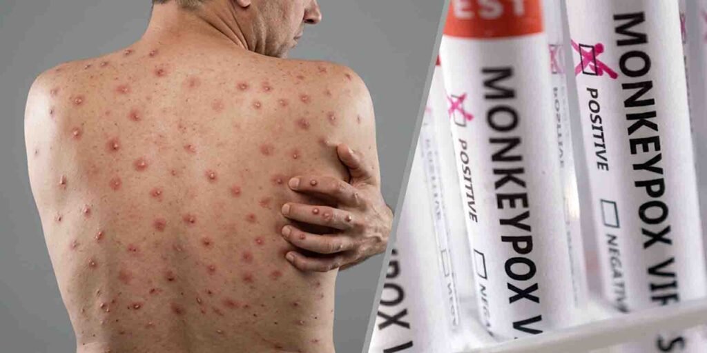 سندھ منکی پاکس کیسز اموات