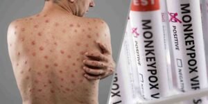 سندھ منکی پاکس کیسز: 9 اموات، 25 کیسز کی تصدیق