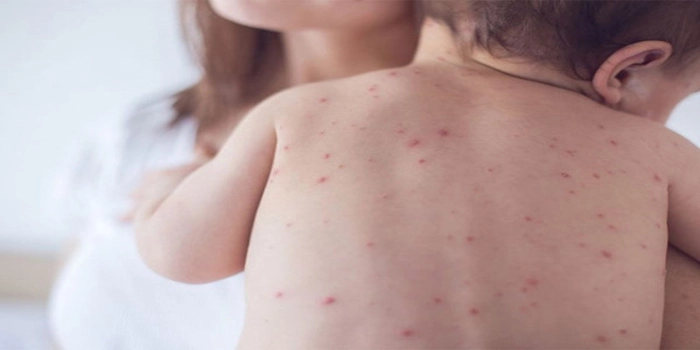 سندھ میں خسرہ کی وبا کے باعث اسپتال میں زیر علاج بچے
